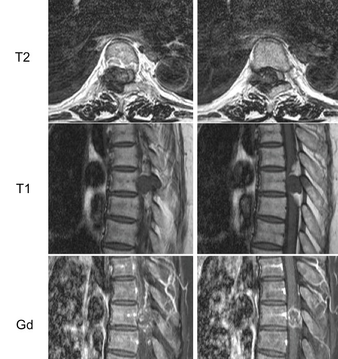 Figure 3 for case Chondrosarcoma ( RID4140 ) of the vertebral column